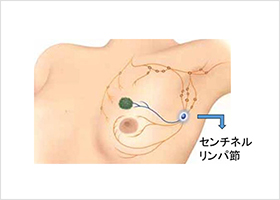 センチネルリンパ節のイメージ図