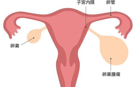 卵巣 嚢腫 再発