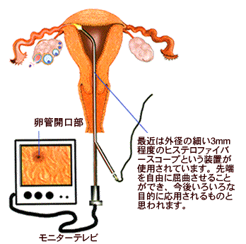 内 膜 掻爬 子宮 子宮内掻爬術が必要なのはどういう場合ですか？